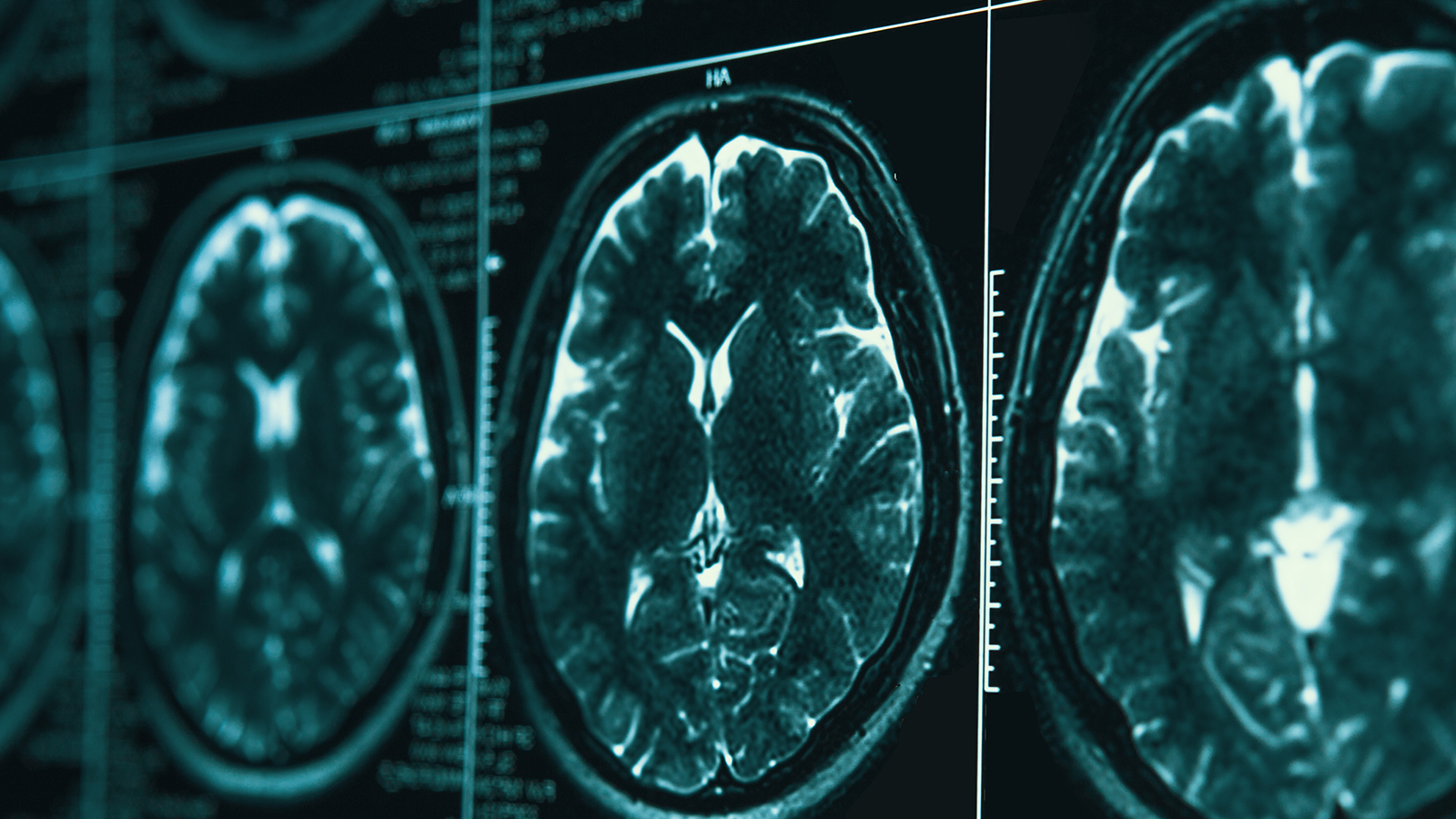 MRI scans of the brain.